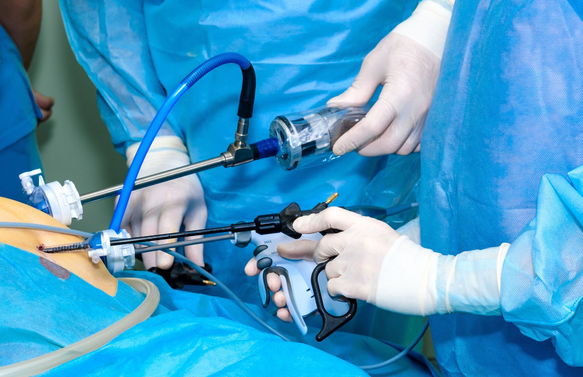 Laparoscopic and Open Surgery